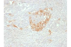 Formalin-fixed, paraffin-embedded human Neuroendocrine tumor stained with NSE gamma Mouse Monoclonal Antibody (NSE-P2). (ENO2/NSE 抗体  (AA 416-433))