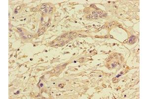 Immunohistochemistry of paraffin-embedded human pancreatic cancer using ABIN7169312 at dilution of 1:100 (PPP1CC 抗体  (Catalytic Subunit))