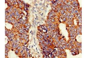 Immunohistochemistry of paraffin-embedded human colon cancer using ABIN7144717 at dilution of 1:100 (Asparagine Synthetase 抗体  (AA 364-551))