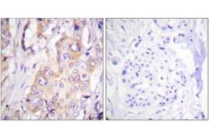 Immunohistochemistry analysis of paraffin-embedded human breast carcinoma, using MEK1 (Phospho-Thr286) Antibody. (MEK1 抗体  (pThr286))