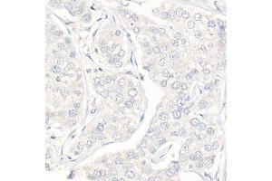 Immunohistochemistry of paraffin-embedded Human triple negative breast cancer (negative control sample) using Progesterone Receptor Rabbit mAb (ABIN7269533) at dilution of 1:100 (40x lens). (Progesterone Receptor 抗体)