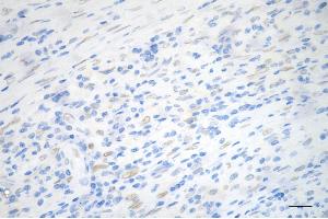Immunohistochemistry was performed on paraffin-embedded human sigmoid colon carcinoma using PCYT1A antibody (ABIN7799789), 1:200). (Recombinant PCYT1A 抗体)