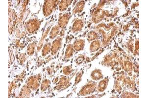 IHC-P Image BCL2L12 antibody detects BCL2L12 protein at cytosol and nucleus on human colon carcinoma by immunohistochemical analysis. (BCL2L12 抗体  (C-Term))