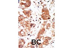 Formalin-fixed and paraffin-embedded human cancer tissue reacted with the PIM1 polyclonal antibody  , which was peroxidase-conjugated to the secondary antibody, followed by DAB staining. (PIM1 抗体  (C-Term))