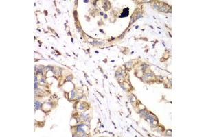 Immunohistochemistry of paraffin-embedded human liver cancer using HADHA antibody. (HADHA 抗体)