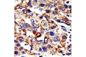 Formalin-fixed and paraffin-embedded human cancer tissue reacted with the primary antibody, which was peroxidase-conjugated to the secondary antibody, followed by AEC staining. (HDAC8 抗体  (N-Term))