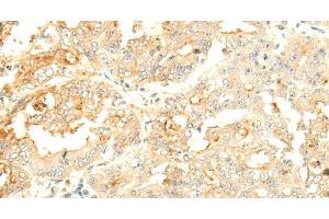 Immunohistochemistry of paraffin-embedded Human gastric cancer tissue using SOCS6 Polyclonal Antibody at dilution 1:50