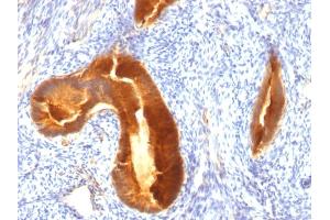 Formalin-fixed, paraffin-embedded human Endometrial Carcinoma stained with MUC-1 / CA15-3 / EMA Mouse Monoclonal Antibody (MUC1/955). (MUC1 抗体)