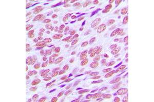 Immunohistochemical analysis of Cyclin E1 staining in human breast cancer formalin fixed paraffin embedded tissue section. (Cyclin E1 抗体  (C-Term))