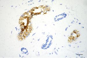 Immunohistochemistry was performed on paraffin-embedded human breast carcinoma using keratin 18 antibody (ABIN7799173), 1:200).