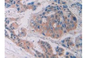 Detection of PTK7 in Human Breast cancer Tissue using Polyclonal Antibody to Tyrosine Protein Kinase 7 (PTK7) (Tyrosine Protein Kinase 7 (AA 853-1070) 抗体)