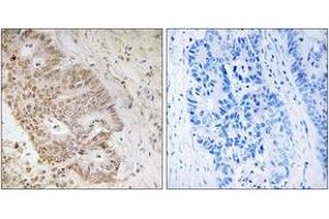 Immunohistochemistry analysis of paraffin-embedded human colon carcinoma tissue, using ZNF592 Antibody. (ZNF592 抗体  (AA 961-1010))