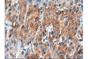 Immunohistochemical staining of paraffin-embedded Carcinoma of liver using anti-PTCH1 (ABIN2452537) mouse monoclonal antibody. (Patched 1 抗体  (AA 122-436))