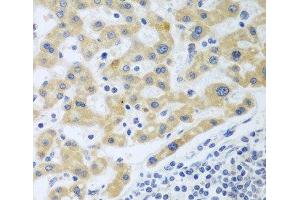 Immunohistochemistry of paraffin-embedded Human liver cancer using SHBG Polyclonal Antibody at dilution of 1:100 (40x lens). (SHBG 抗体)