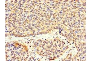 Immunohistochemistry of paraffin-embedded human ovarian cancer using ABIN7175332 at dilution of 1:100 (VTA1 抗体  (AA 23-307))