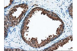 Immunohistochemical staining of paraffin-embedded Adenocarcinoma of Human ovary tissue using anti-ACAT2 mouse monoclonal antibody. (ACAT2 抗体)