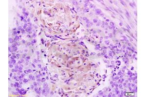 Formalin-fixed and paraffin embedded human esophageal carcinoma tissue labeled with Anti-Cathepsin B Polyclonal Antibody, Unconjugated (ABIN687412) at 1:200 followed by conjugation to the secondary antibody, (SP-0023), and DAB staining (Cathepsin B 抗体  (AA 251-339))