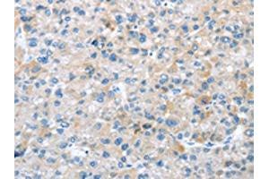 The image on the left is immunohistochemistry of paraffin-embedded Human liver cancer tissue using ABIN7192908(TRIM47 Antibody) at dilution 1/20, on the right is treated with synthetic peptide. (TRIM47 抗体)