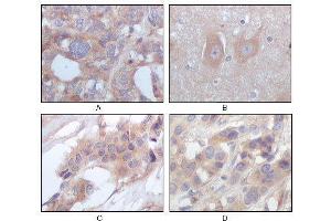 Immunohistochemical analysis of paraffin-embedded human ovary carcinoma (A), normal cerebrum tissues (B), breast infiltrating carcinoma (C) and breast infiltrating carcinoma (D), showing cytoplasmic localization using STYK1/NOK mouse mAb with DAB staining. (STYK1 抗体)