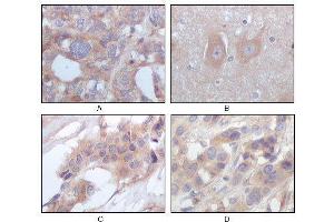 Immunohistochemical analysis of paraffin-embedded human ovary carcinoma (A), normal cerebrum tissues (B), breast infiltrating carcinoma (C) and breast infiltrating carcinoma (D), showing cytoplasmic localization using STYK1/NOK mouse mAb with DAB staining. (STYK1 抗体)