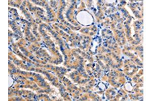 The image on the left is immunohistochemistry of paraffin-embedded Human thyroid cancer tissue using ABIN7128359(ALG8 Antibody) at dilution 1/30, on the right is treated with fusion protein. (ALG8 抗体)