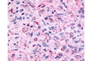Anti-MTNR1B / MT2 antibody IHC of human Brain, Glioblastoma. (Melatonin Receptor 1B 抗体  (Extracellular Domain))
