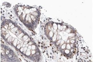 ABIN6266552 at 1/100 staining human Colorectal carcinoma tissue sections by IHC-P. (GRM8 抗体  (C-Term))