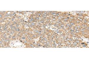 Immunohistochemistry of paraffin-embedded Human liver cancer tissue using C1orf101 Polyclonal Antibody at dilution of 1:65(x200) (C1orf101 抗体)