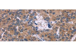 Immunohistochemistry of paraffin-embedded Human liver cancer tissue using SKI Polyclonal Antibody at dilution 1:40 (SKI 抗体)