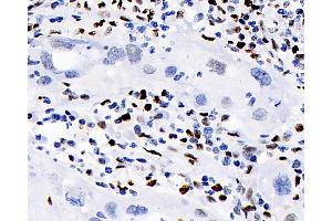 Immunohistochemistry analysis of paraffin-embedded human lymphoma using ERK 2 Polyclonal Antibody at dilution of 1:100. (ERK2 抗体)