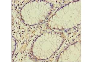Immunohistochemistry of paraffin-embedded human colon cancer using ABIN7172672 at dilution of 1:100 (TAF12 抗体  (AA 1-161))