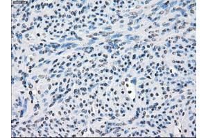 Immunohistochemical staining of paraffin-embedded Adenocarcinoma of colon tissue using anti-FOSL1mouse monoclonal antibody. (FOSL1 抗体)