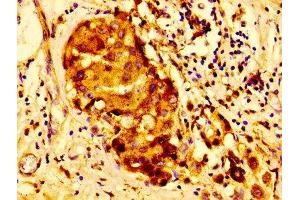 Immunohistochemistry of paraffin-embedded human breast cancer using ABIN7147000 at dilution of 1:100 (Cathepsin D 抗体  (AA 67-403))