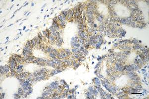 Immunohistochemistry was performed on paraffin-embedded human sigmoid colon carcinoma using catenin beta 1 antibody (ABIN7797928), 1:200).