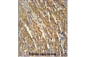 PDXD1 Antibody (C-term) (ABIN651141 and ABIN2840095) immunohistochemistry analysis in formalin fixed and paraffin embedded human cervix carcinoma followed by peroxidase conjugation of the secondary antibody and DAB staining. (PDXDC1 抗体  (C-Term))