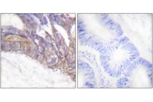 Immunohistochemistry analysis of paraffin-embedded human colon carcinoma, using LAT (Phospho-Tyr191) Antibody.