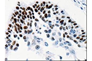 The image on the left is immunohistochemistry of paraffin-embedded Human cervical cancer tissue using ABIN7131338(TGIF2LX Antibody) at dilution 1/25, on the right is treated with fusion protein. (TGIF2LX 抗体)