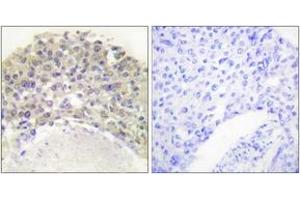 Immunohistochemistry analysis of paraffin-embedded human breast carcinoma, using Shc (Phospho-Tyr349) Antibody. (SHC1 抗体  (pTyr349))