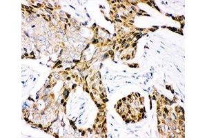 IHC-P: Ubiquitin antibody testing of human mammary cancer tissue (Ubiquitin 抗体  (AA 77-152))