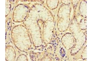 Immunohistochemistry of paraffin-embedded human gastric cancer using ABIN7161926 at dilution of 1:100 (NRIP3 抗体  (AA 1-241))