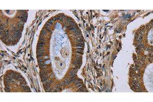 Immunohistochemistry of paraffin-embedded Human colon cancer tissue using NEFH Polyclonal Antibody at dilution 1:40 (NEFH 抗体)
