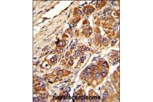 Formalin-fixed and paraffin-embedded human hepatocarcinoma with KLC1 Antibody (Center), which was peroxidase-conjugated to the secondary antibody, followed by DAB staining. (KLC1 抗体  (AA 389-415))