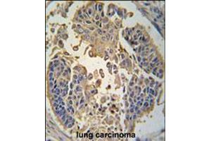 Formalin-fixed and paraffin-embedded human lung carcinoma tissue reacted with RIP3 (RIPK3) antibody , which was peroxidase-conjugated to the secondary antibody, followed by DAB staining.