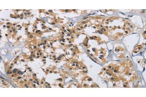 Immunohistochemistry of paraffin-embedded Human thyroid cancer tissue using IL12RB2 Polyclonal Antibody at dilution 1:40 (IL12RB2 抗体)