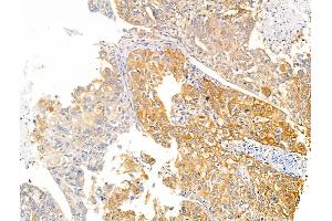 ABIN6260480 and ABIN6266502 at 1/100 staining Human liver cancer by IHC-P.