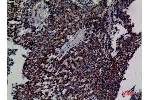 Immunohistochemistry (IHC) analysis of paraffin-embedded Human Lung Cancer, antibody was diluted at 1:100. (DCI 抗体  (C-Term))