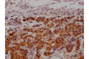IHC image of ABIN7127610 diluted at 1:100 and staining in paraffin-embedded human breast cancer performed on a Leica BondTM system. (Recombinant MAPKAP Kinase 2 抗体)
