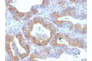 IHC testing of FFPE human ovarian carcinoma with LHR antibody (clone LHCGR/1417). (LHCGR 抗体  (N-Term))
