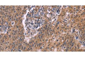 Immunohistochemistry of paraffin-embedded Human liver cancer tissue using HSD11B2 Polyclonal Antibody at dilution 1:35 (HSD11B2 抗体)
