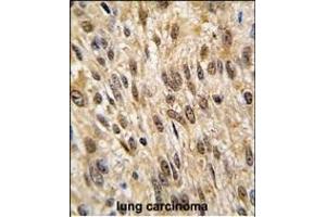 Formalin-fixed and paraffin-embedded human lung carcinoma tissue reacted with PTPN6 antibody (Center), which was peroxidase-conjugated to the secondary antibody, followed by DAB staining.